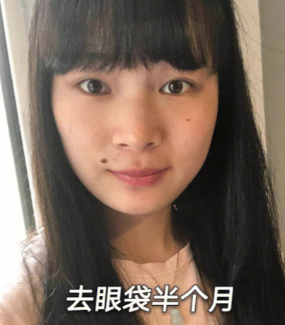 去眼袋手术