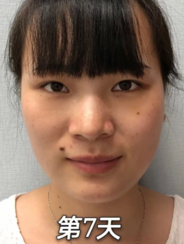 去眼袋手术