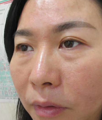 眼袋