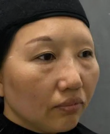 去眼袋手术