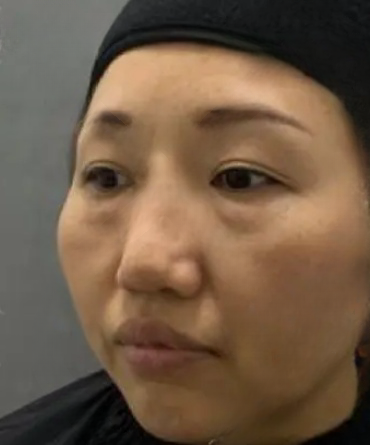 去眼袋手术
