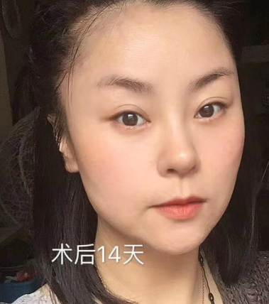 眼袋