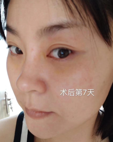 眼袋
