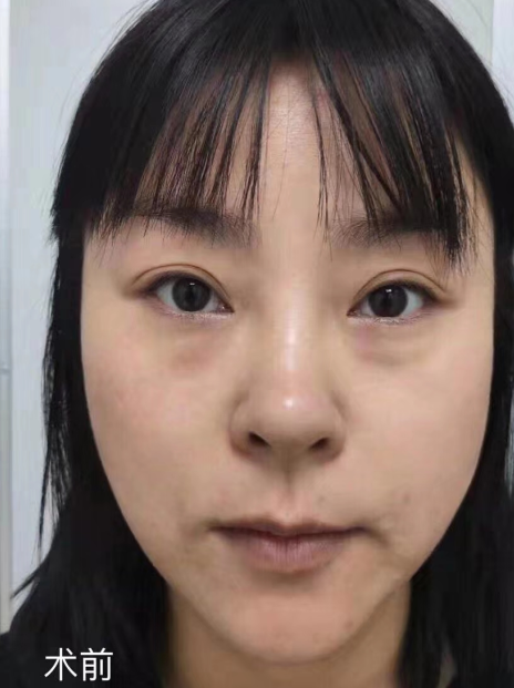 眼袋