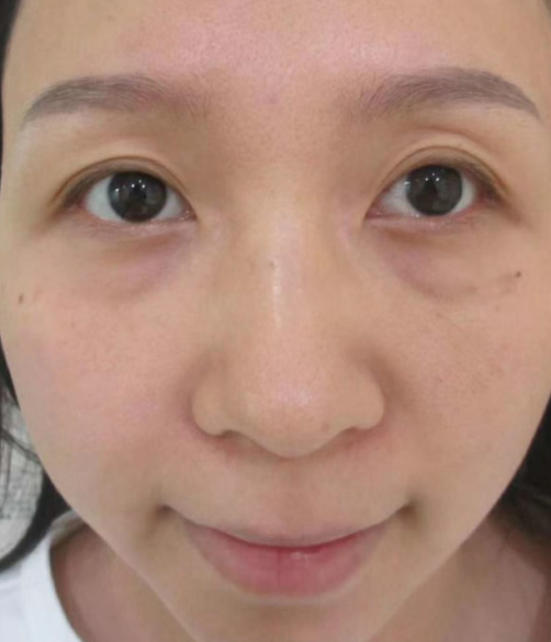眼袋
