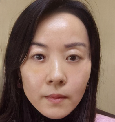 去眼袋手术