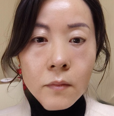 去眼袋手术