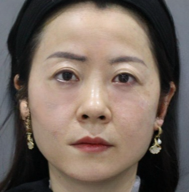 去眼袋手术