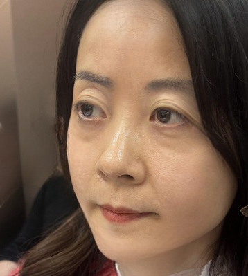去眼袋手术