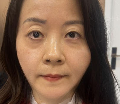 去眼袋手术
