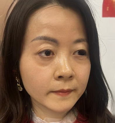 去眼袋手术