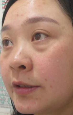 眼袋