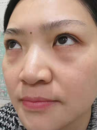 眼袋