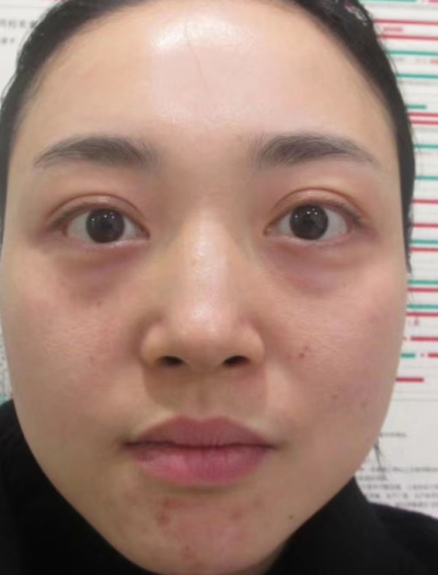 眼袋