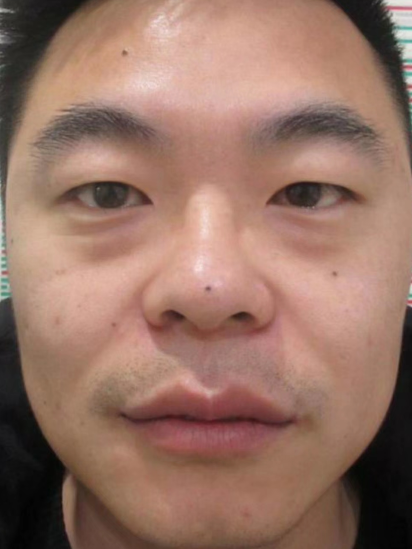眼袋