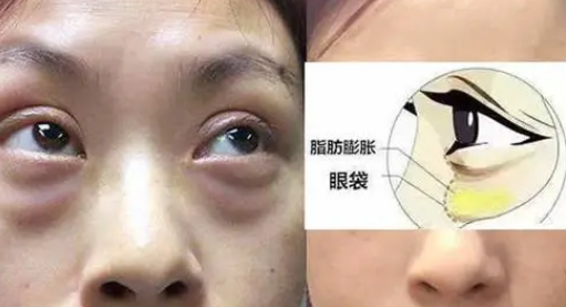 泪沟