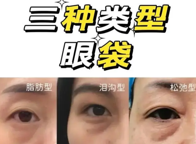 泪沟