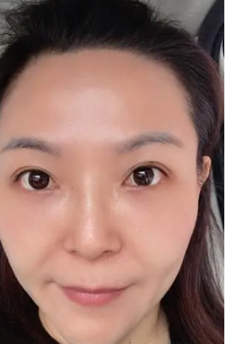 眼袋