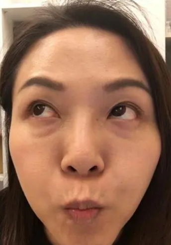 眼袋