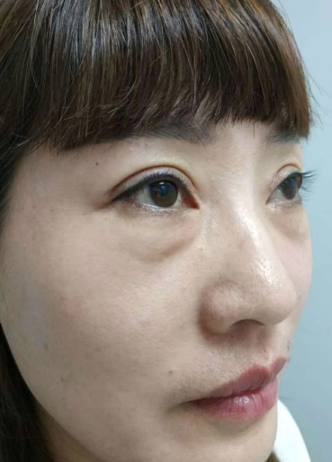 眼袋