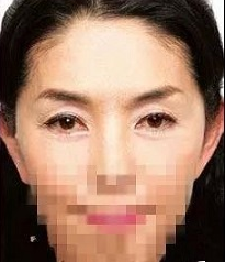 眼袋