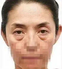 眼袋