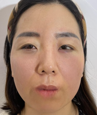 去眼袋手术