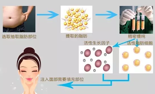 自体脂肪丰胸