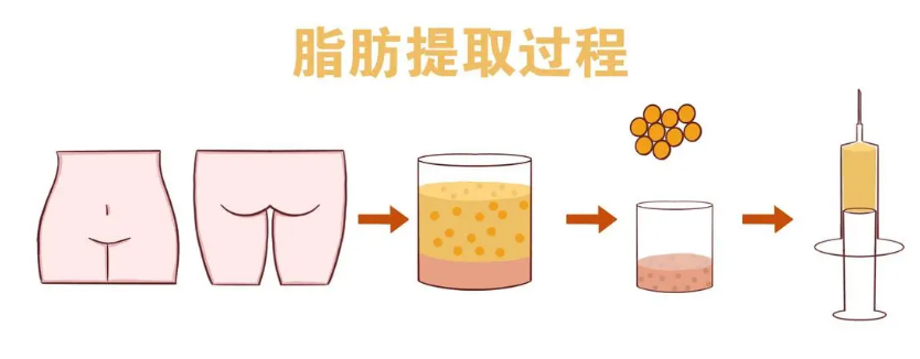 自体脂肪丰胸