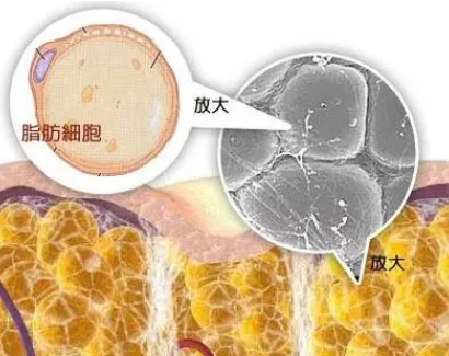 自体脂肪丰胸