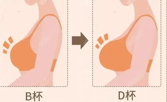 自体脂肪丰胸