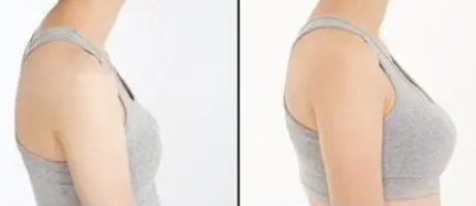 自体脂肪丰胸