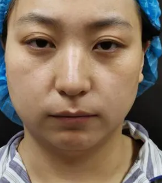 自体脂肪填充