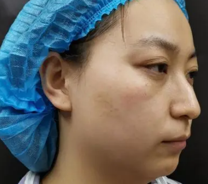 自体脂肪填充