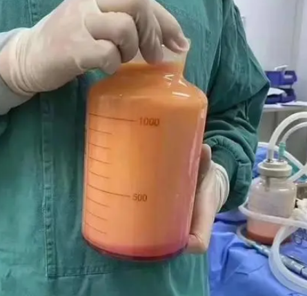 自体脂肪培养丰胸