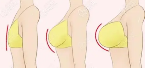 自体脂肪培养丰胸