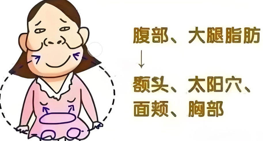 自体脂肪培养丰胸
