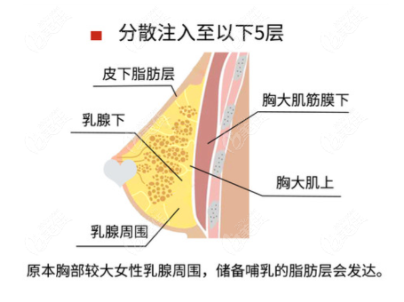 自体脂肪培养丰胸