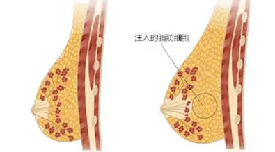 自体脂肪培养丰胸