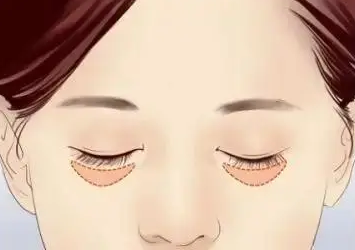 眼袋