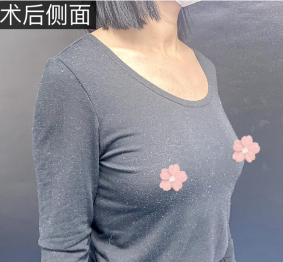 自体脂肪丰胸