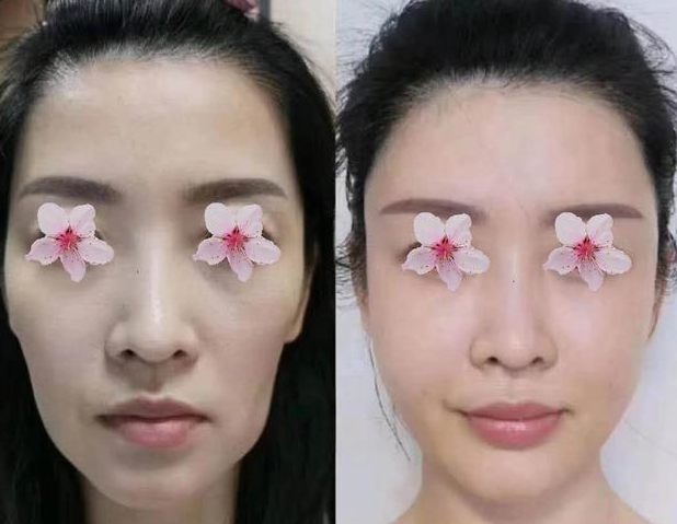 自体脂肪填充