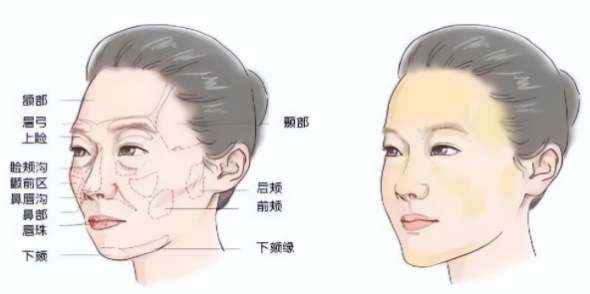 自体脂肪培养丰胸