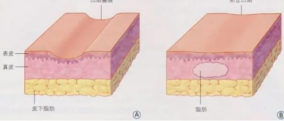 自体脂肪填充