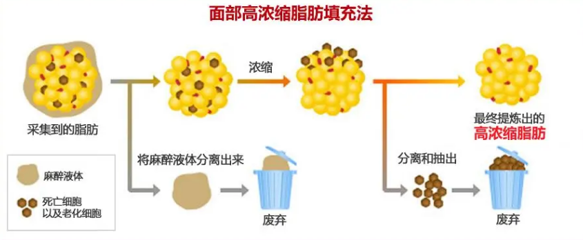 自体脂肪培养丰胸