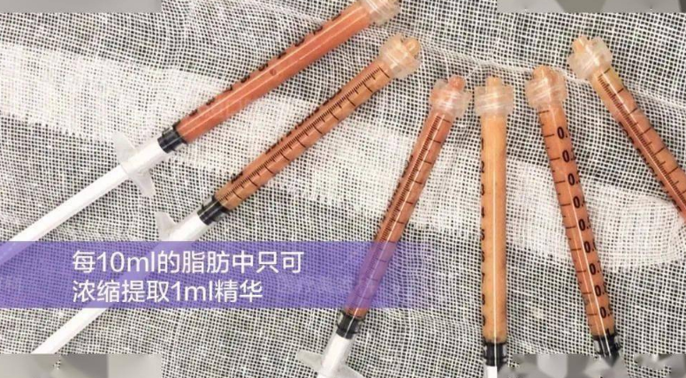 自体脂肪培养丰胸
