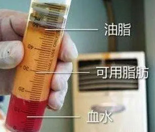 自体脂肪培养丰胸