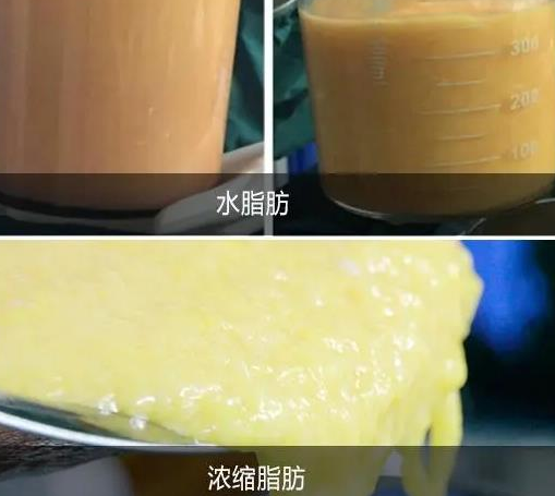 自体脂肪培养丰胸