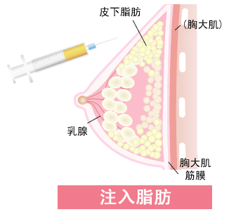 自体脂肪培养丰胸