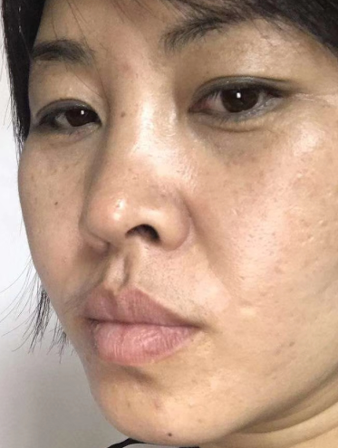 眼袋手术